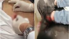 بالفيديو / مشاهد مروعة لاستخراج الرصاص المطاطي من اجساد المتظاهرين اثناء مواجهات وسط بيروت