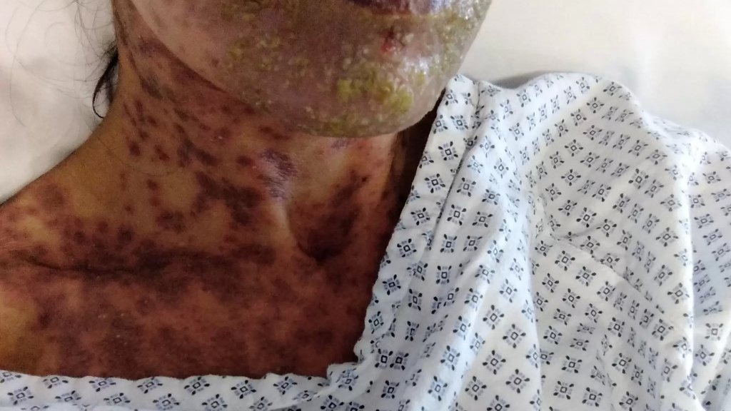 شابة تنشر قصة نجاتها من حالة نادرة هددت حياتها وتصيب واحداً من بين مليون شخص سنوياً.. تركيبة دواء تسبب لحالتها المعاناة!