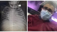 طبيب لبناني ينشر صورة شعاعية لطفل ويعلق: "الصورة الأخيرة لصبي عمره 9 سنوات مصاب بكورونا توفى اليوم..الحالة الوحيدة التي مرت علي بمضاعفات خطيرة لمثل هذا العمر"