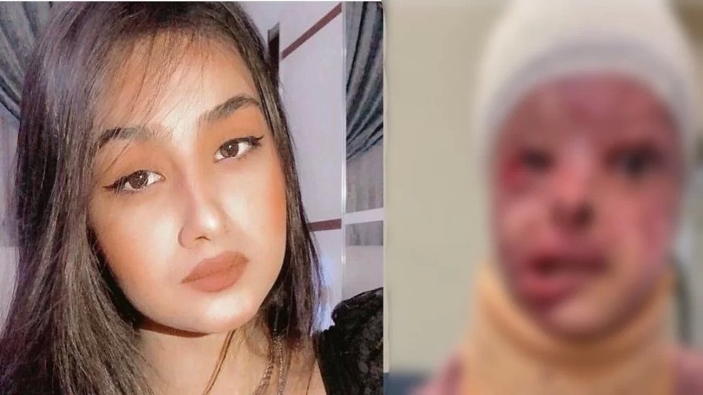 "أنقذوا الأميرة مريم".. حملة تضامن كبيرة في العراق مع شابّة شوهها شاب بمادة "التيزاب" بعدما رفضت الزواج منه! 