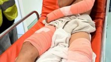 بالصورة/ كلب شارد هاجم إبن الـ 10 سنوات أثناء وجوده في منزل ذويه في بلدة كفرملكي: تعرض لعضات في كتفه ورجليه