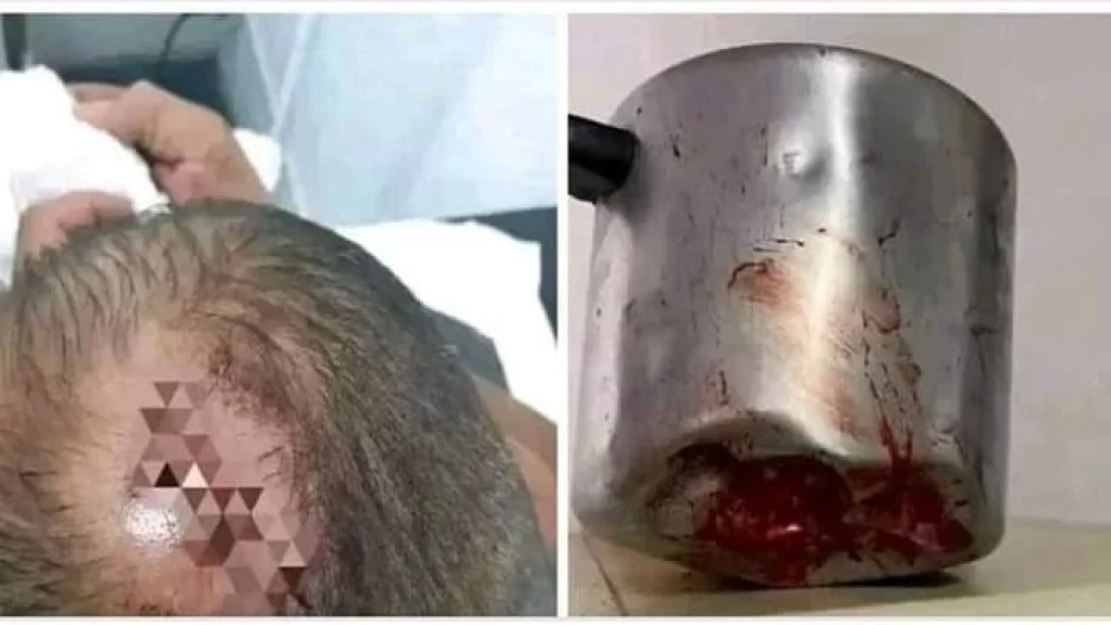 امرأة ضربت زوجها بـ "طنجرة ضغط" إثر اكتشافها لخيانته لها في كولومبيا.. والصور العائدة للخبر تدّاول على أنّها لزوج ضربته امرأته بـ "ركوة" في طرابلس بعدما اشتكى من "الشوربة"!