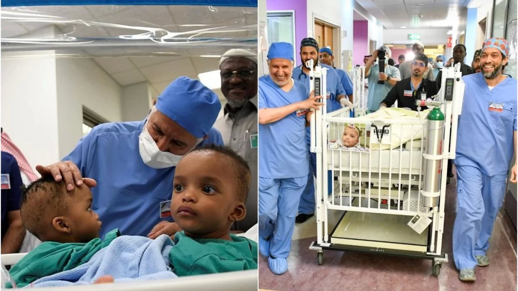 بالصور/ نجاح عملية فصل التوأم السيامي &laquo;حسانة وحسينة&raquo; بعد جراحة معقدة استغرقت 14 ساعة