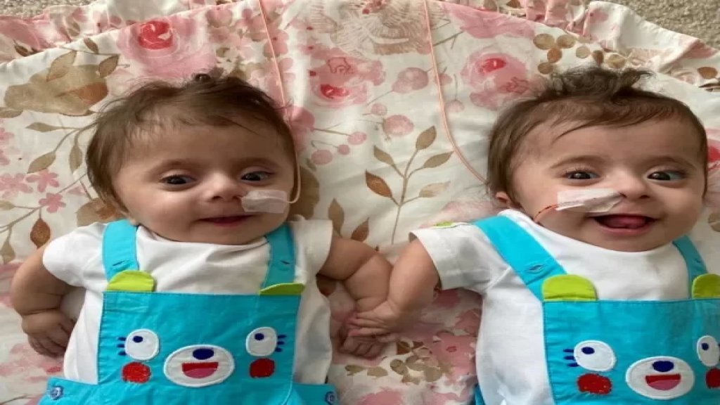 ولادة توأم بحالة طبية نادرة: "عظام هشة كقشرة البيض".. قد يؤدي العناق إلى قتلهما!